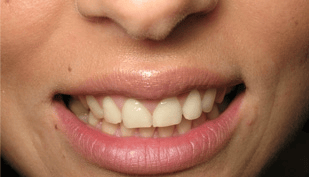 Veneers before