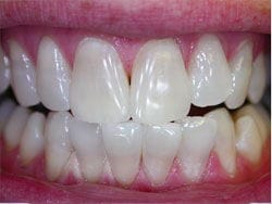 Zoom Whitening before