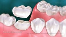 Filling Versus Crown 005 image