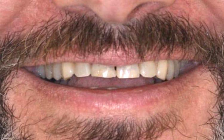 9. Patient SS (6 teeth)_ 6 porcelain crowns on upper front teeth Before.jpg