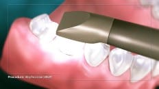 Filling Versus Crown 006 image