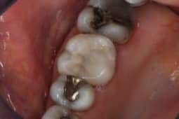 Onlays after