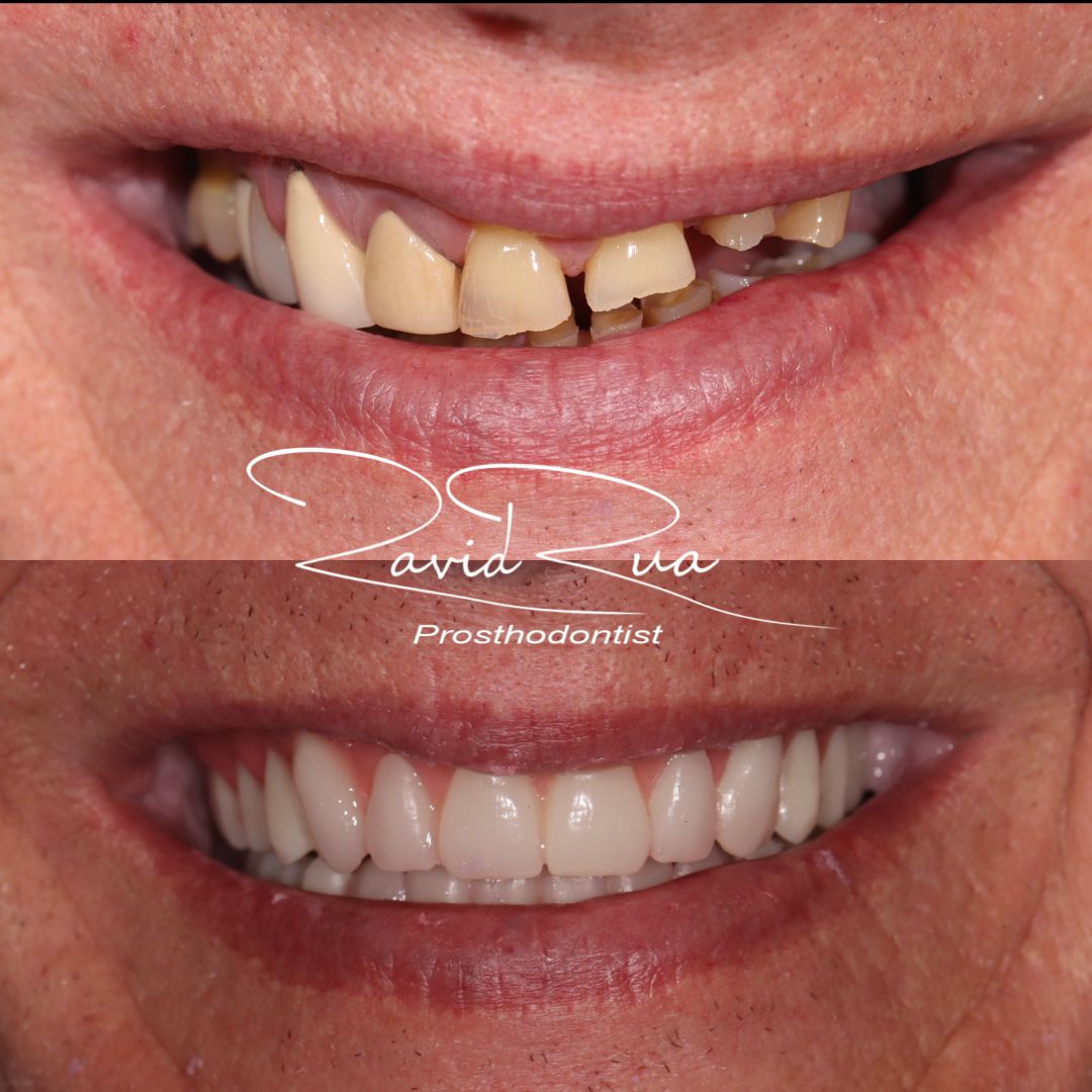 TC Cape Coral Case 20 Top denture with a natural apperence