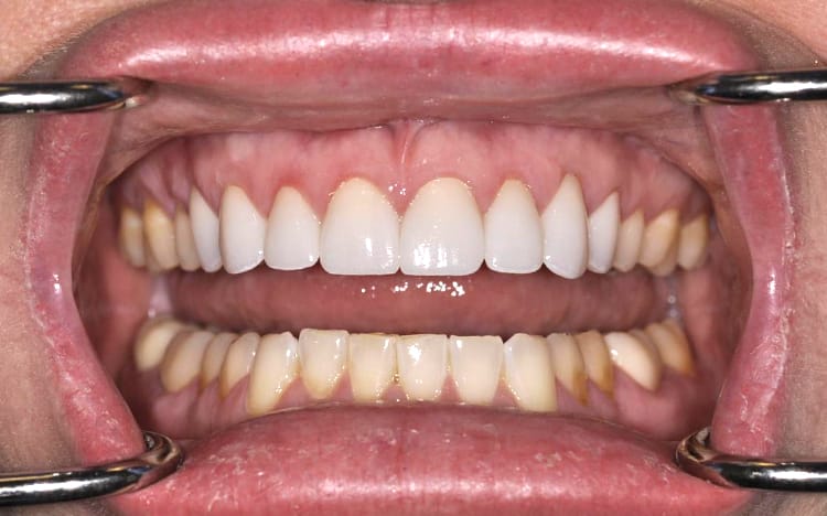 11. Patient KM (8 teeth)_ 8 porcelain crowns on upper front teeth After