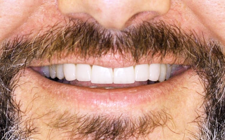9. Patient SS (6 teeth)_ 6 porcelain crowns on upper front teeth