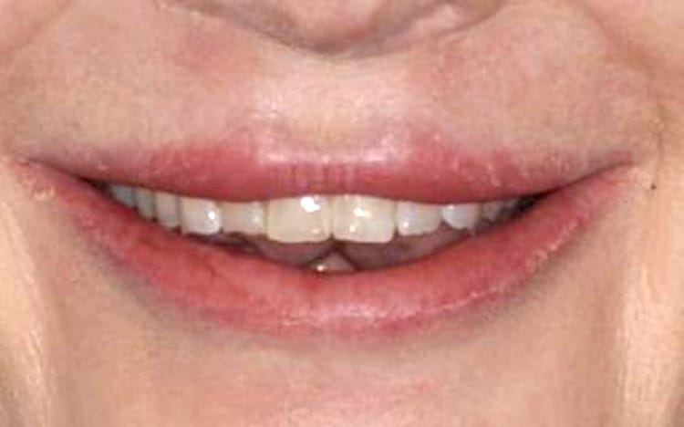 11. Patient KM (8 teeth)_ 8 porcelain crowns on upper front teeth Before(1)