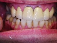 Veneers before