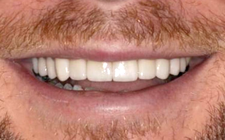 20. Patient AT (12 teeth)_ Porcelain crowns on upper 12 teeth After