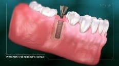 Single Implant (Posterior- Healing Cap) 003