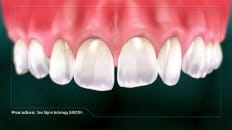 Clear Aligner Technology (Impression) 001