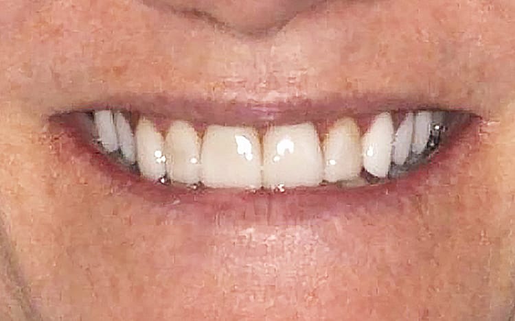 19. Patient MC (10 teeth)_ Mix of porcelain veneers and crowns on upper 10 teeth Before