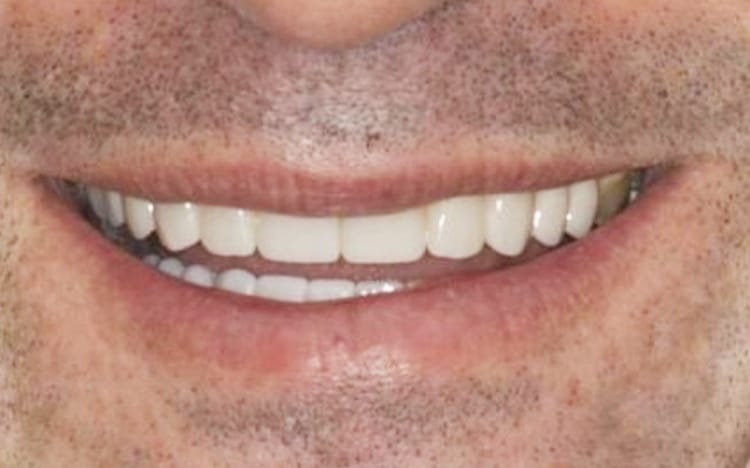 25. Patient PT (22 teeth)_ Combination of orthodontic work prior to 12 porcelain crowns on upper teeth and 10 porcelain crowns on lower teeth After