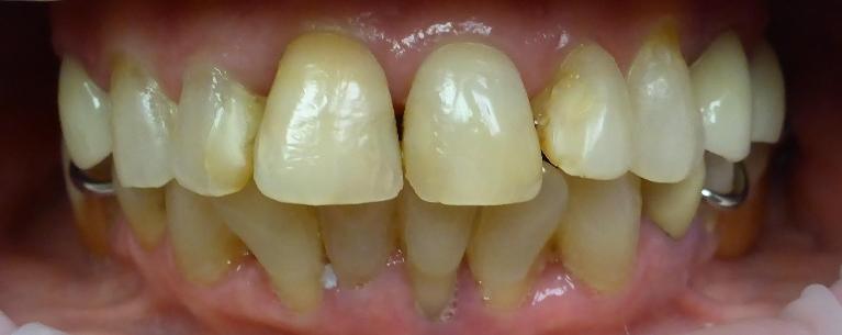 Grapevine Before Cosmetic Dentistry 2
