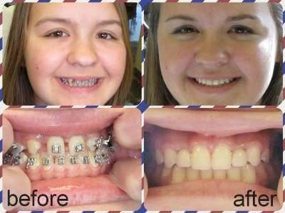 Before and after