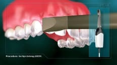 Clear Aligner Technology (Impression) 003