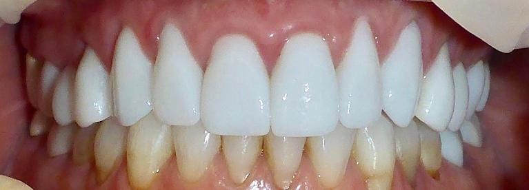 Grapevine After Patient Unhappy With Previous Cosmetic Dentistry