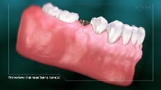 Single Implant (Posterior- Healing Cap) 004