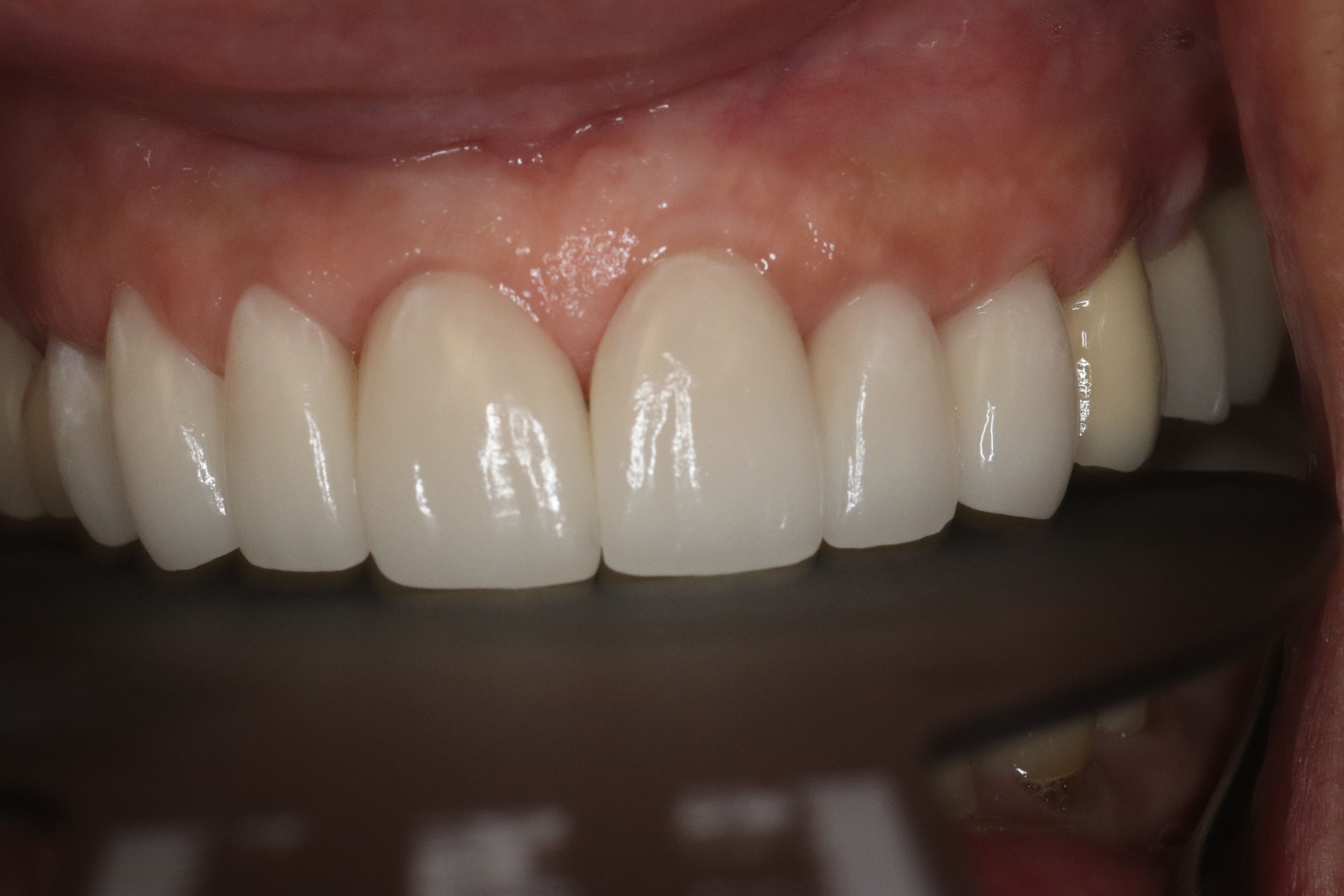 Rasner Smile gallery after 6