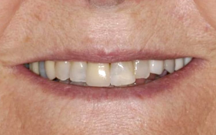 10. Patient CS (6 teeth)_ 6 porcelain crowns on front teeth Before
