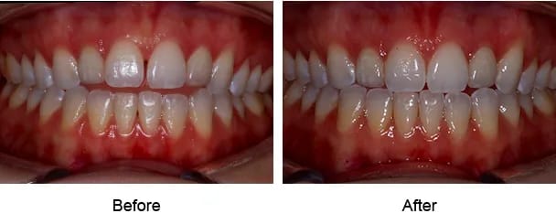 Smile Galley Before and After