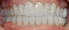 Full mouth reconstruction after Rotter