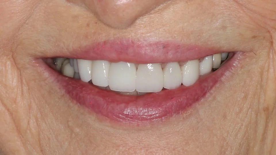 Anastasia Smile 10 after image