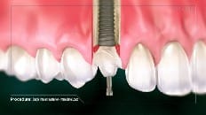 Single Implant (Anterior - Immediate Load) 004