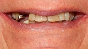 Dental Implants Before