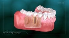 Bridge Versus An Implant 006