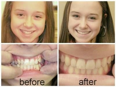 Before and After
