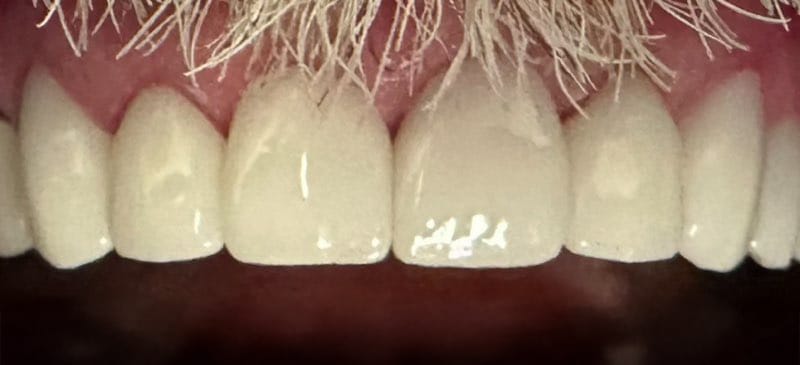 Bright Smiles Marble Falls Case 2 after