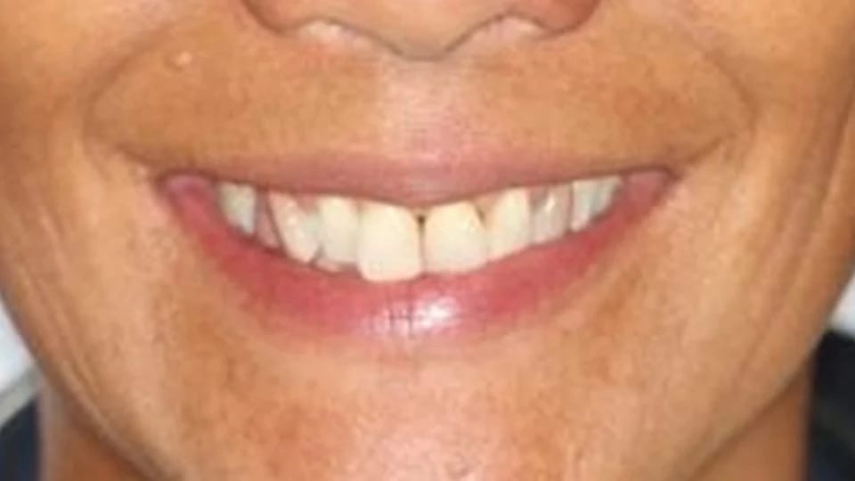 Anastasia Smile 11 before image