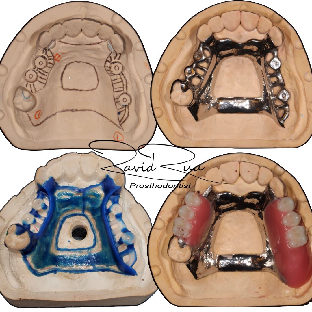 TC Cape Coral Case 8.1 Full mouth rehab with crowns, implants and a top partial
