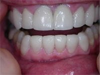 Veneers after