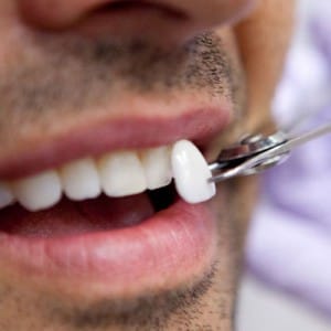 Veneers