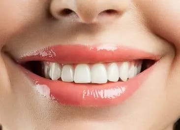 Dental Bonding Porcelain Veneers Dentist St Augustine Dental Bonding Porcelain Veneers Dentist St Augustine