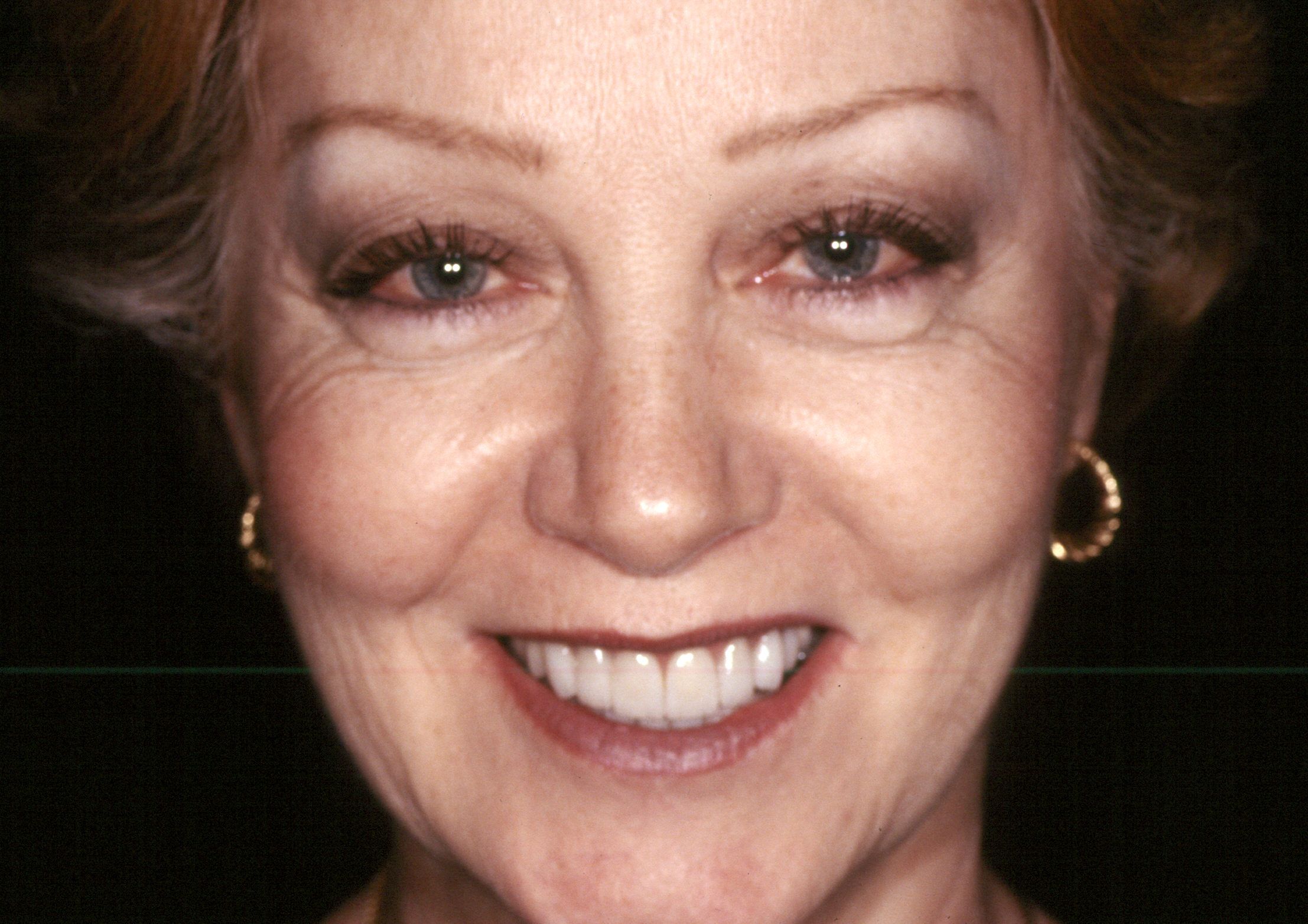 Rasner Smile gallery after 18