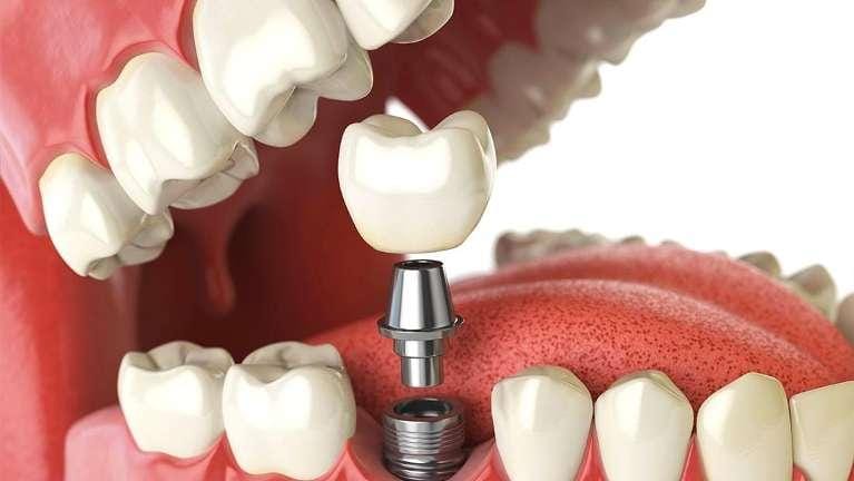 Dental Implant Dental Implant