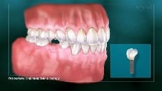 Single Implant (Posterior- Healing Cap) 001