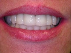 Veneers after