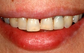 Smile Gallery - before