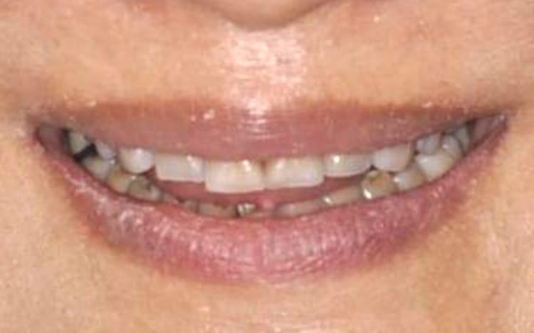23. Patient LL (14 teeth)_ 6 porcelain crowns on upper front teeth and 11 porcelain crowns on lower teeth Before