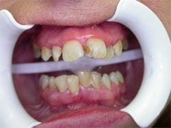 Partial Dentures before
