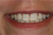 Bonding & Whitening before