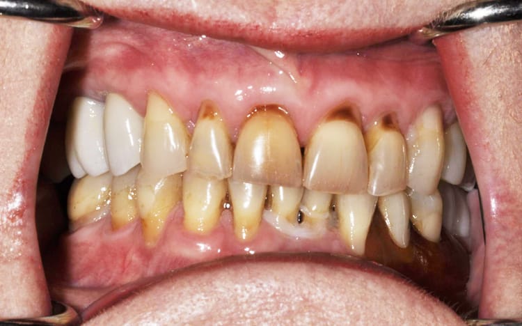 24 (1). Patient ED (18 teeth + 3 implants)_ 8 upper porcelain crowns with 4 porcelain crowns on lower back teeth with and implant supported bridge for lower front 6 teeth Before