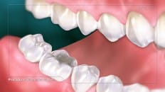Filling Versus Crown 004 image