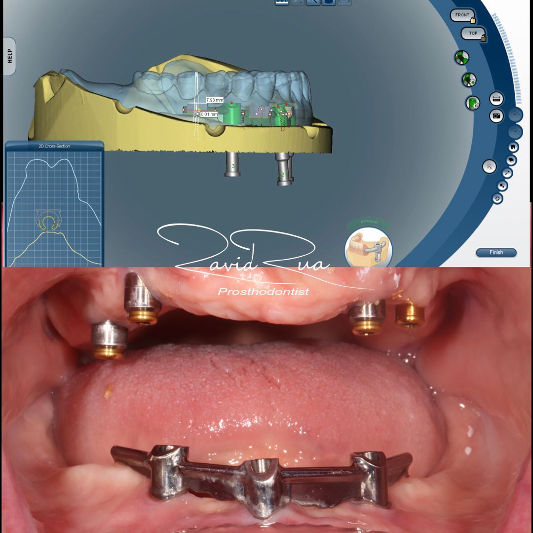 TC Cape Coral Case 13.1 Top denture and mandibular overdenture with a ti bar