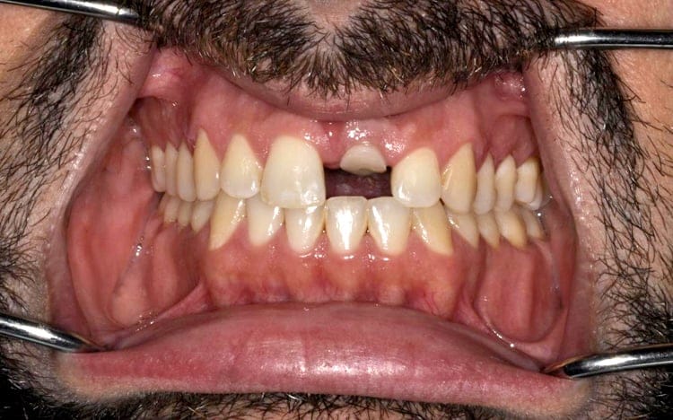 5. Patient KT_ One front tooth porcelain veneer and an adjacent implant with custom tissue shaping and porcelain implant crown Before