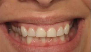 Veneers before