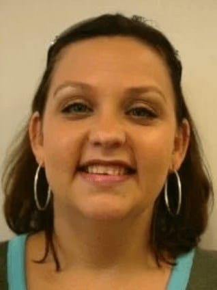 Front Teeth Veneers Before